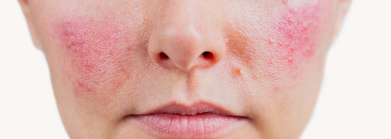 Redness & couperose